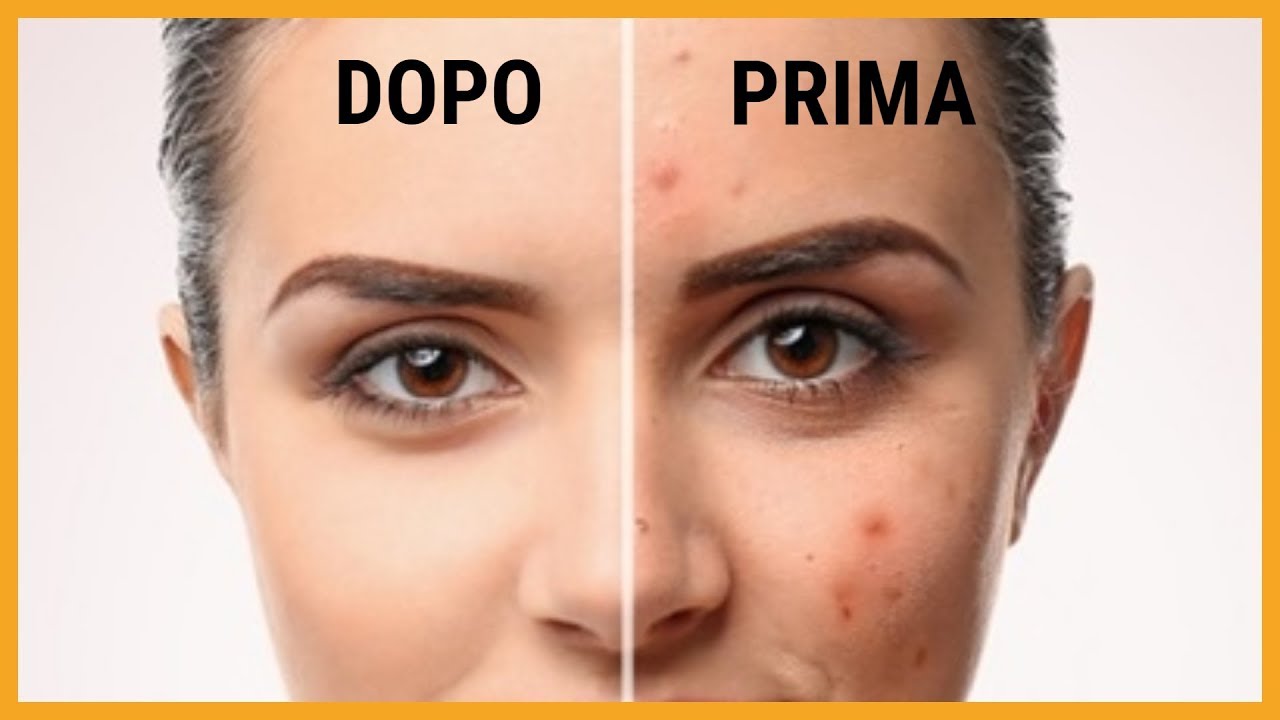 BRUFOCARE Crema Anti Brufoli e Punti Neri | Pelle Pulita e Opaca - Bioniva