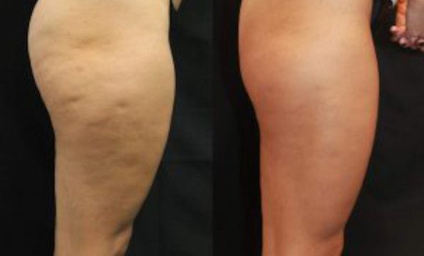 Natural Shape Gel Anticellulite e Smagliature – Pelle Liscia e Tonica - Bioniva