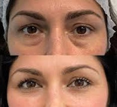 Eye Lissence Patch Occhi al Bamboo con Peptidi e Acido Ialuronico