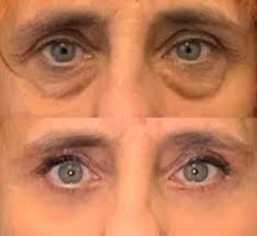 Eye Lissence Patch Occhi al Bamboo con Peptidi e Acido Ialuronico